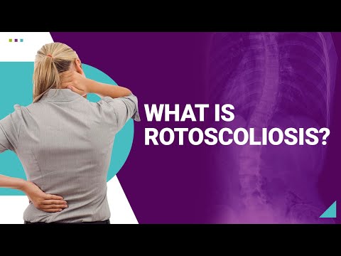 What is Rotoscoliosis?