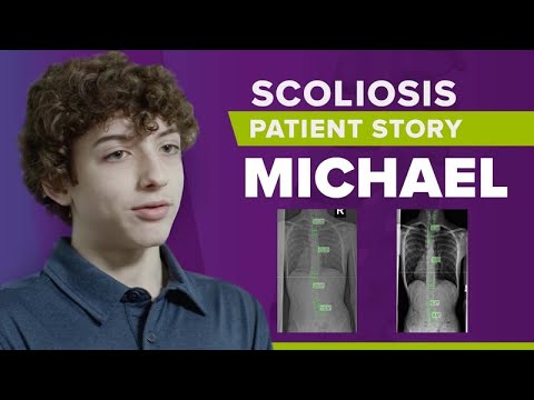 Moderate Scoliosis Treatment Without Surgery: Michael&#039;s Story
