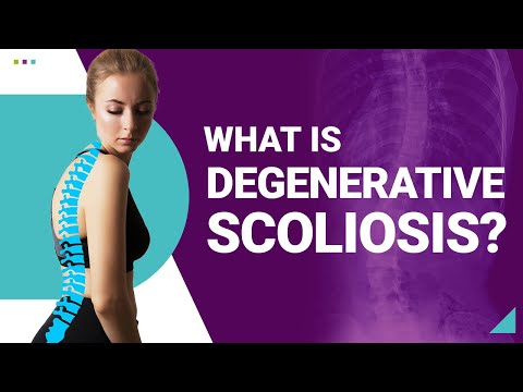 What is Degenerative Scoliosis?
