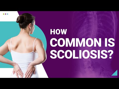 How Common is Scoliosis?