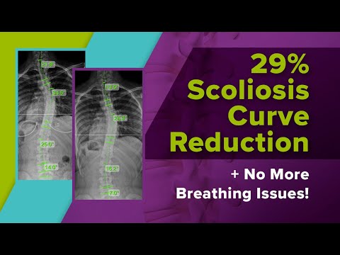 29% Scoliosis Curve Reduction + No More Breathing Issues!