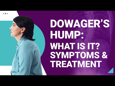 Can Dowager's Hump Be Reversed? - Chiro One