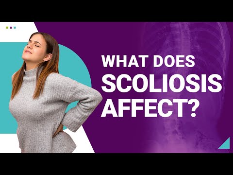 What Does Scoliosis Affect?