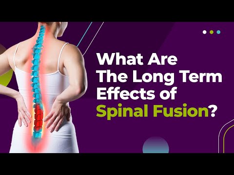 What Are The Long Term Effects of Spinal Fusion?