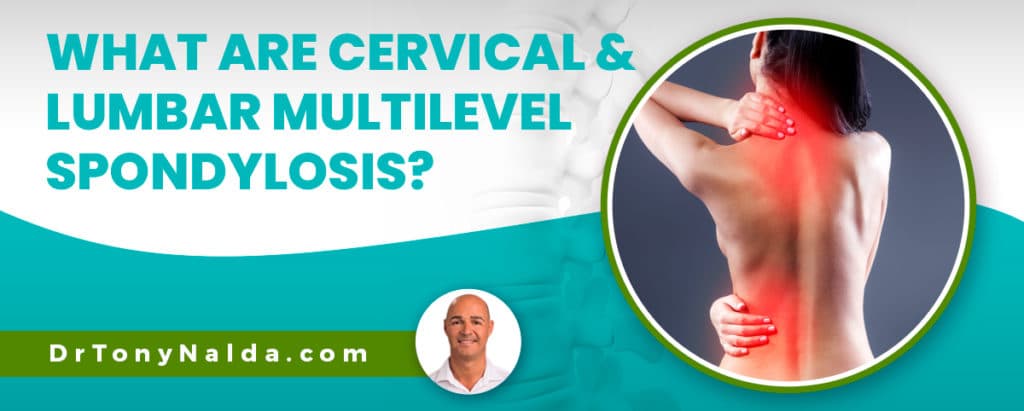 What Are Cervical & Lumbar Multilevel Spondylosis?