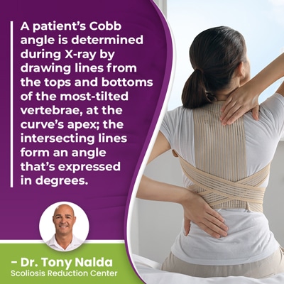 a patients cobb angle