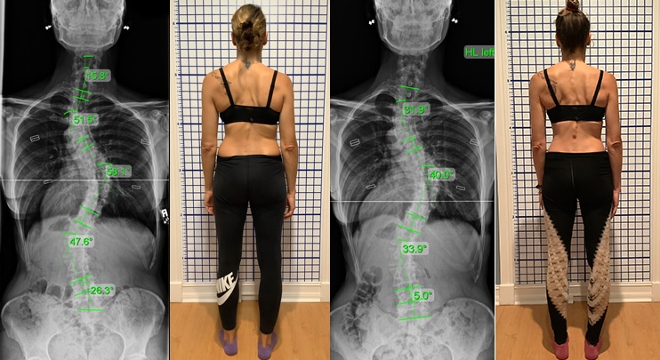 Adult Onset Scoliosis