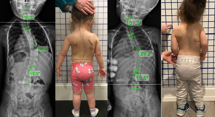 infant scoliosis