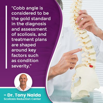 Cobb angle is considered to