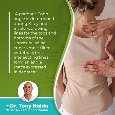A patient's Cobb angle is