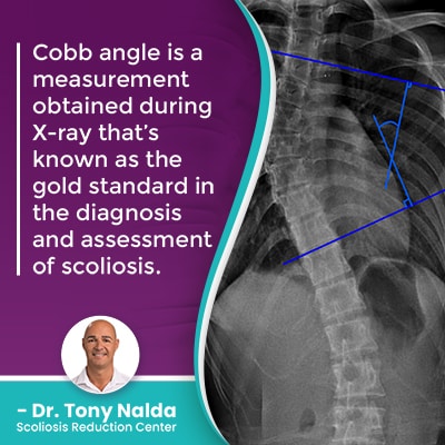 Cobb angle is a measurement