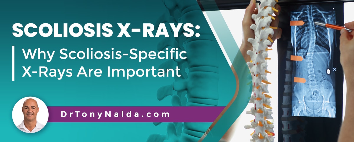 Scoliosis X Rays Why Scoliosis Specific X Rays Are Important
