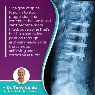 The goal of spinal fusion is
