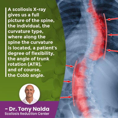 a scoliosis x ray gives