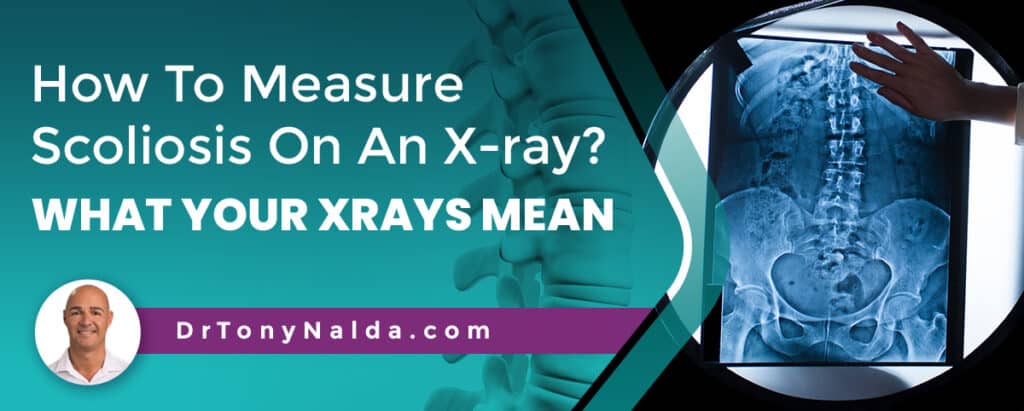 How To Measure Scoliosis On An X-ray? What Your Xrays Mean