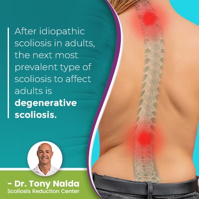 after idiopathic scoliosis in