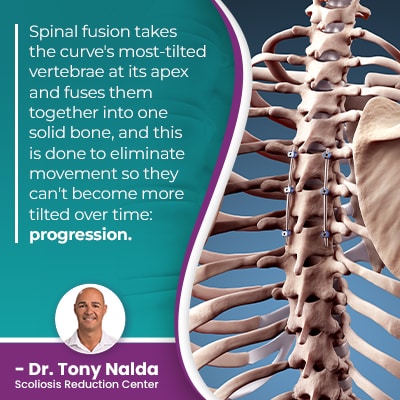 spinal fusion takes the curves