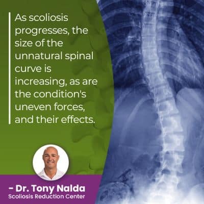 as scoliosis progresses the size