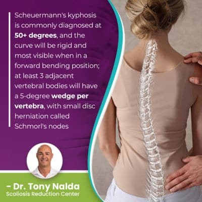 Scheuermann's kyphosis is commonly