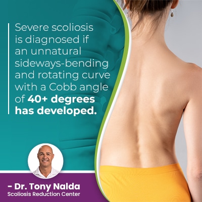 severe scoliosis is diagnosed