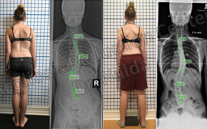 adolescent mod scoliosis