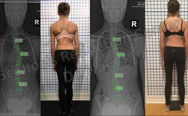 adolescent mod scoliosis