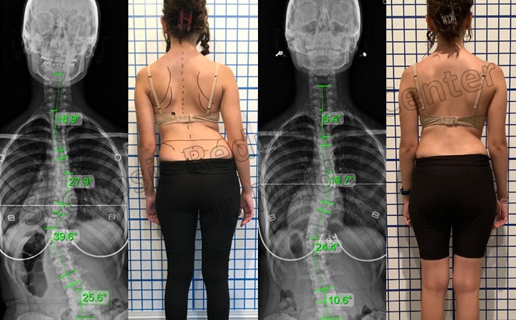 adolescent moderate lumbar