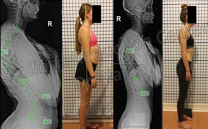 kyphosis treatment results