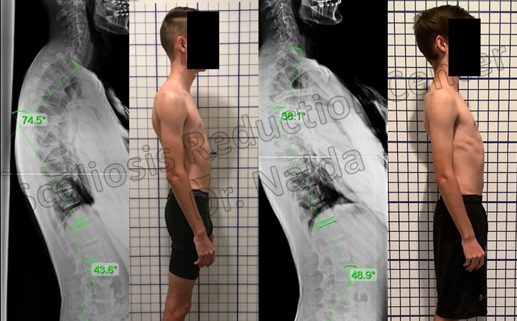 kyphosis treatment results