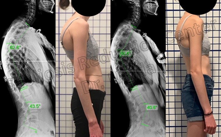 kyphosis treatment results