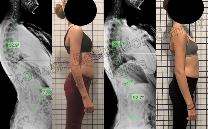 kyphosis treatment results