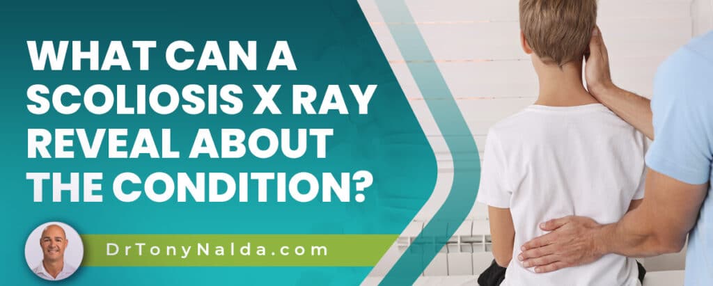What Can a Scoliosis X Ray Reveal About the Condition?