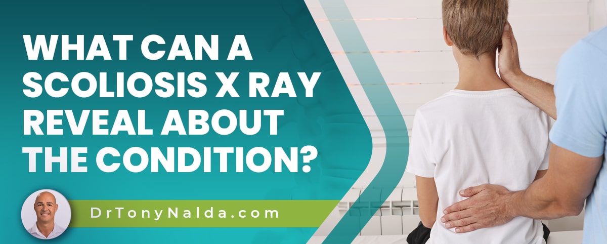 A featured image post for the blog titled:  "what can a scoliosis x ray reveal about the condition"